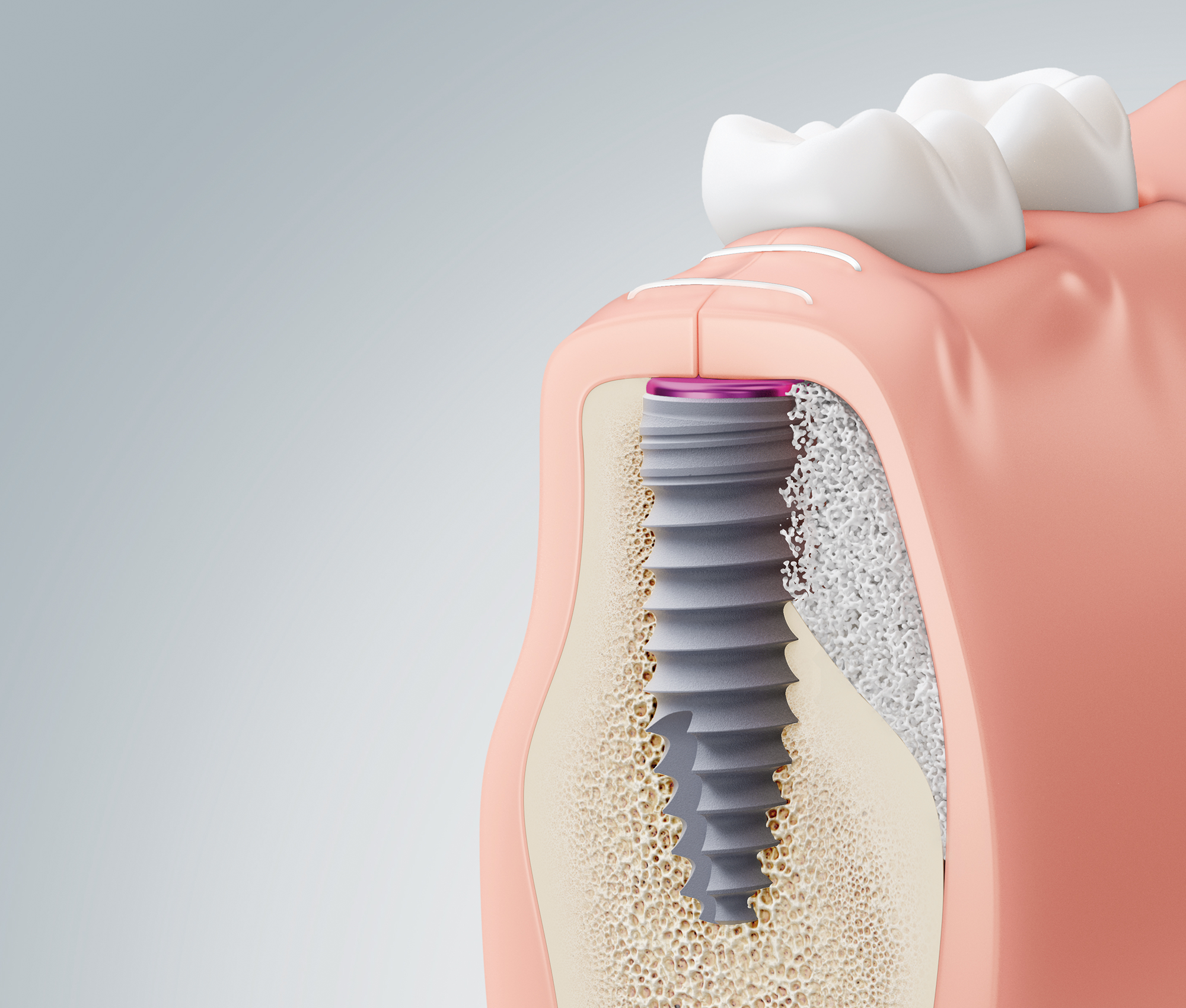 behandlung-weichgewebe-implantat