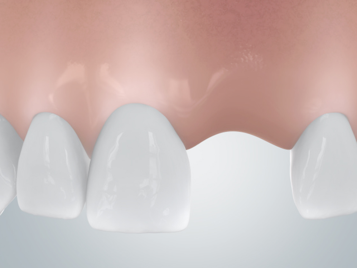 grafik-einzelzahnluecke-vor-implantation