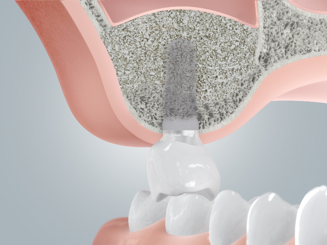 grafik-insertion-eines-implantates-nach-aufbau-des-kieferknochens