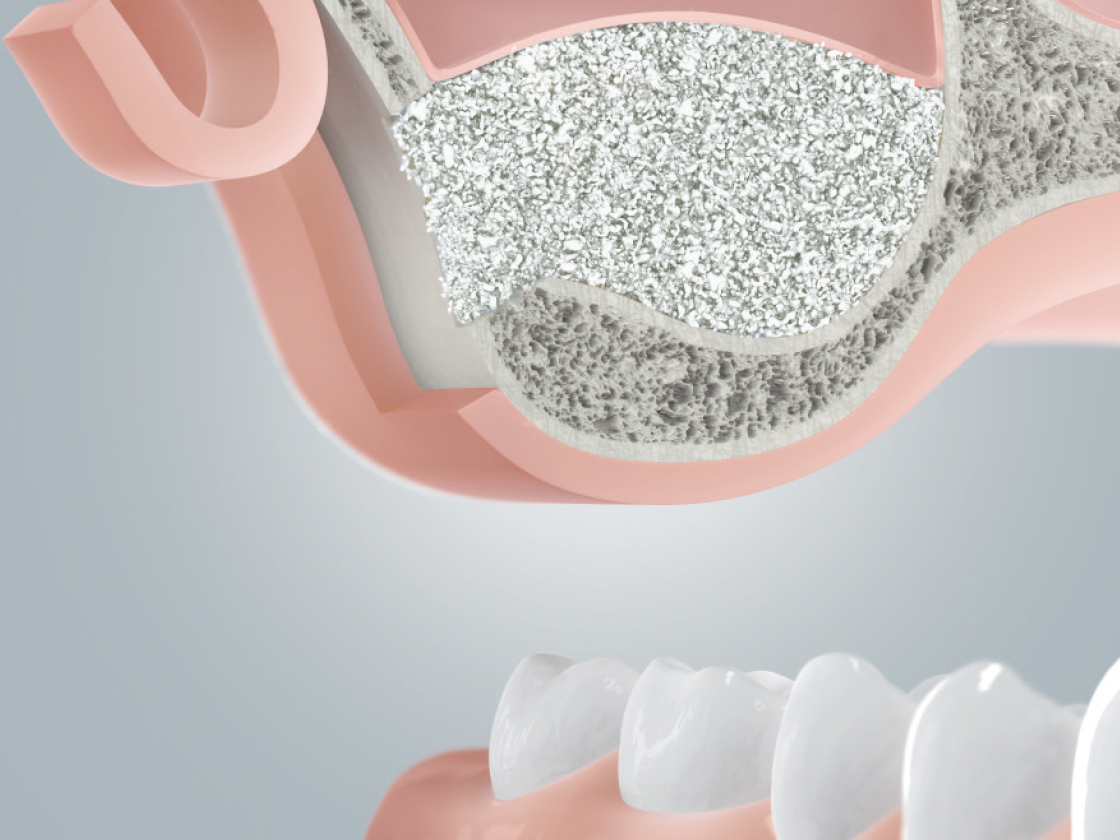 grafik-mit-knochenersatzmaterial-aufgefuellter-hohlraum-nach-sinuslift