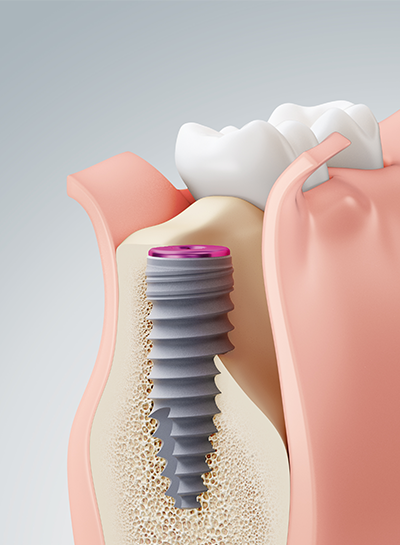 op-implantat